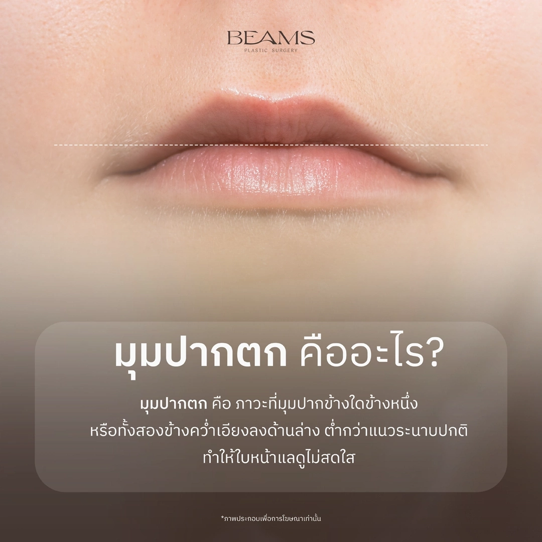 มุมปากตก คืออะไร