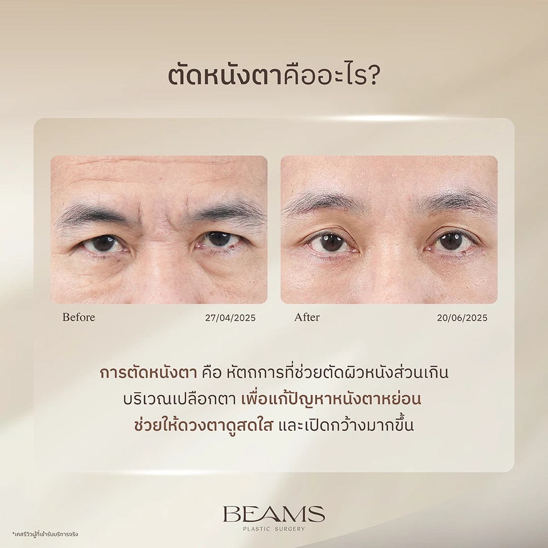ตัดหนังตาคืออะไร