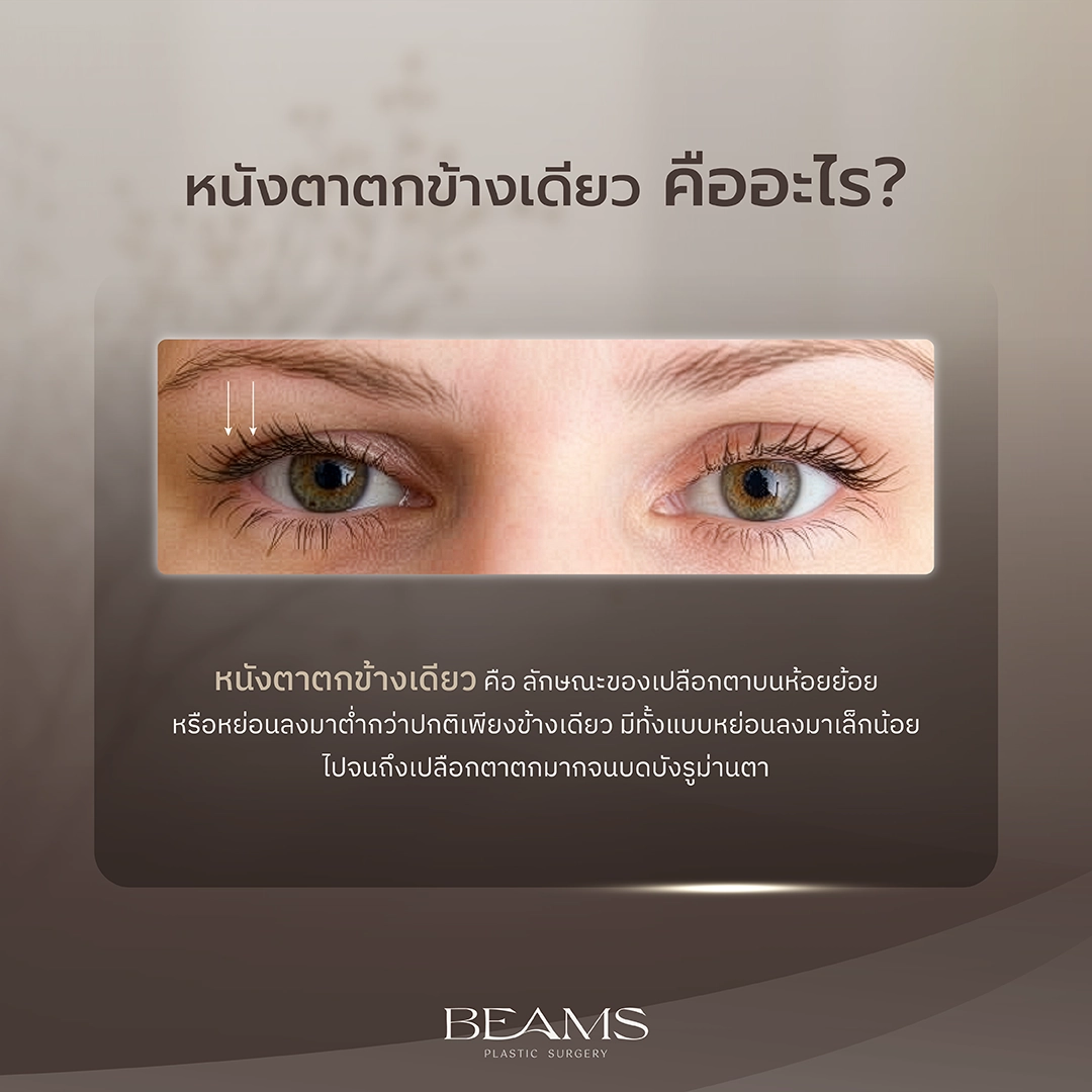 หนังตาตกข้างเดียว คืออะไร