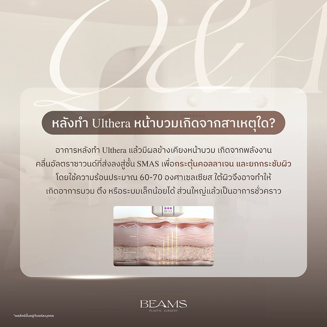 สาเหตุที่หน้าบวมหลังทำ ulthera
