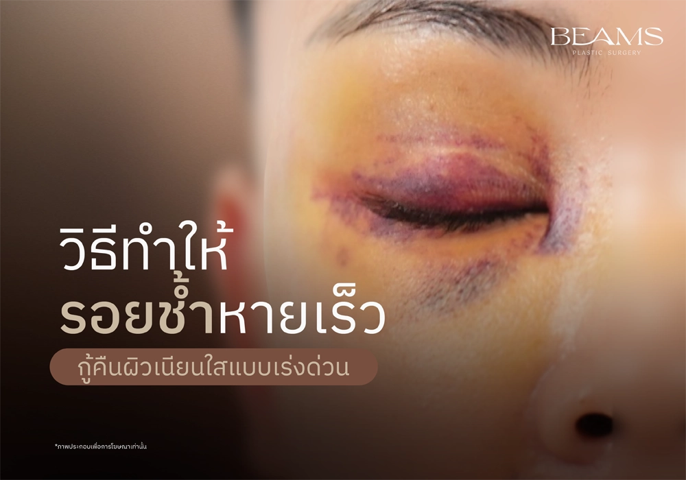 วิธีทำให้รอยช้ำหายเร็ว