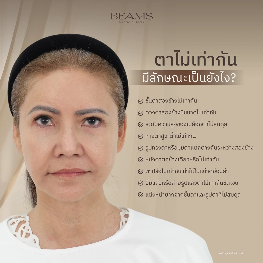 ลักษณะตาไม่เท่ากัน