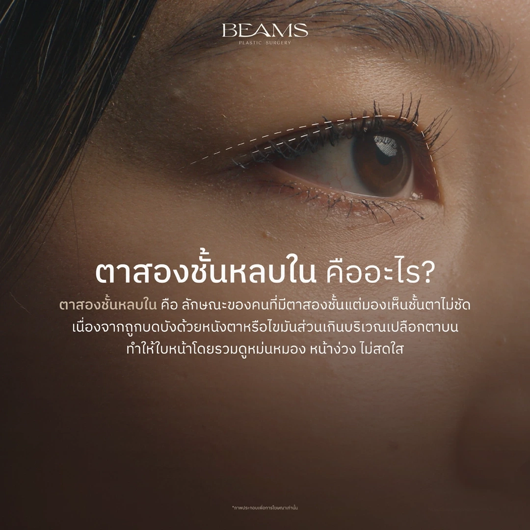 ตาสองชั้นหลบใน คืออะไร