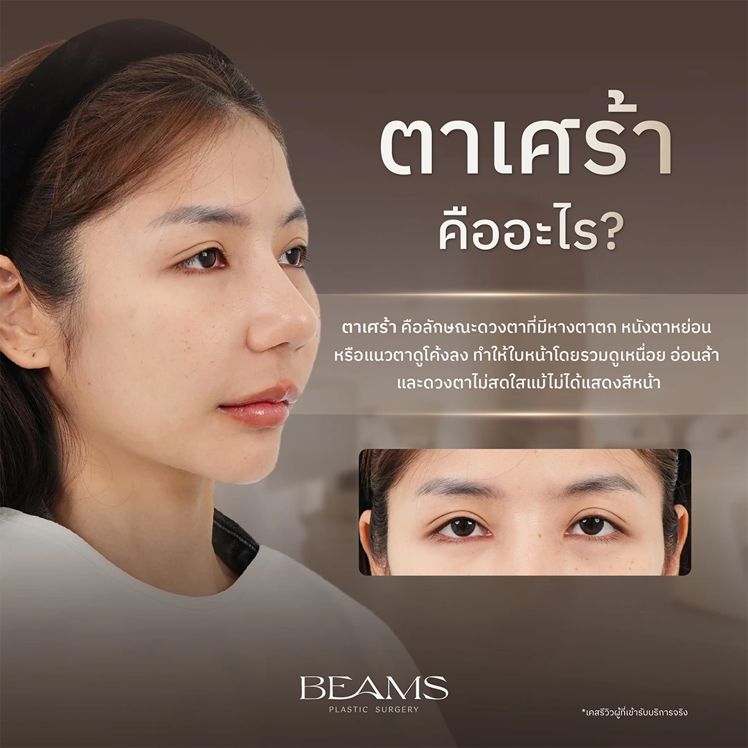 ตาเศร้า คืออะไร