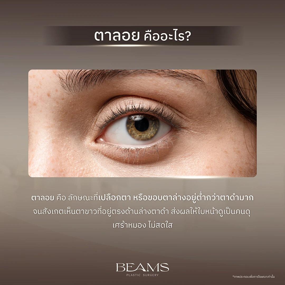 ตาลอย คืออะไร