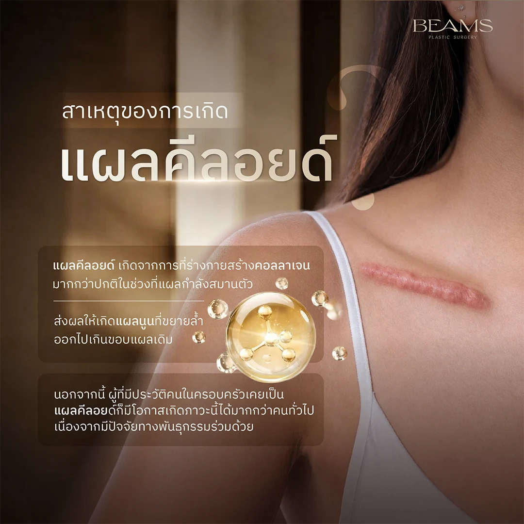 สาเหตุแผลคีลอยด์