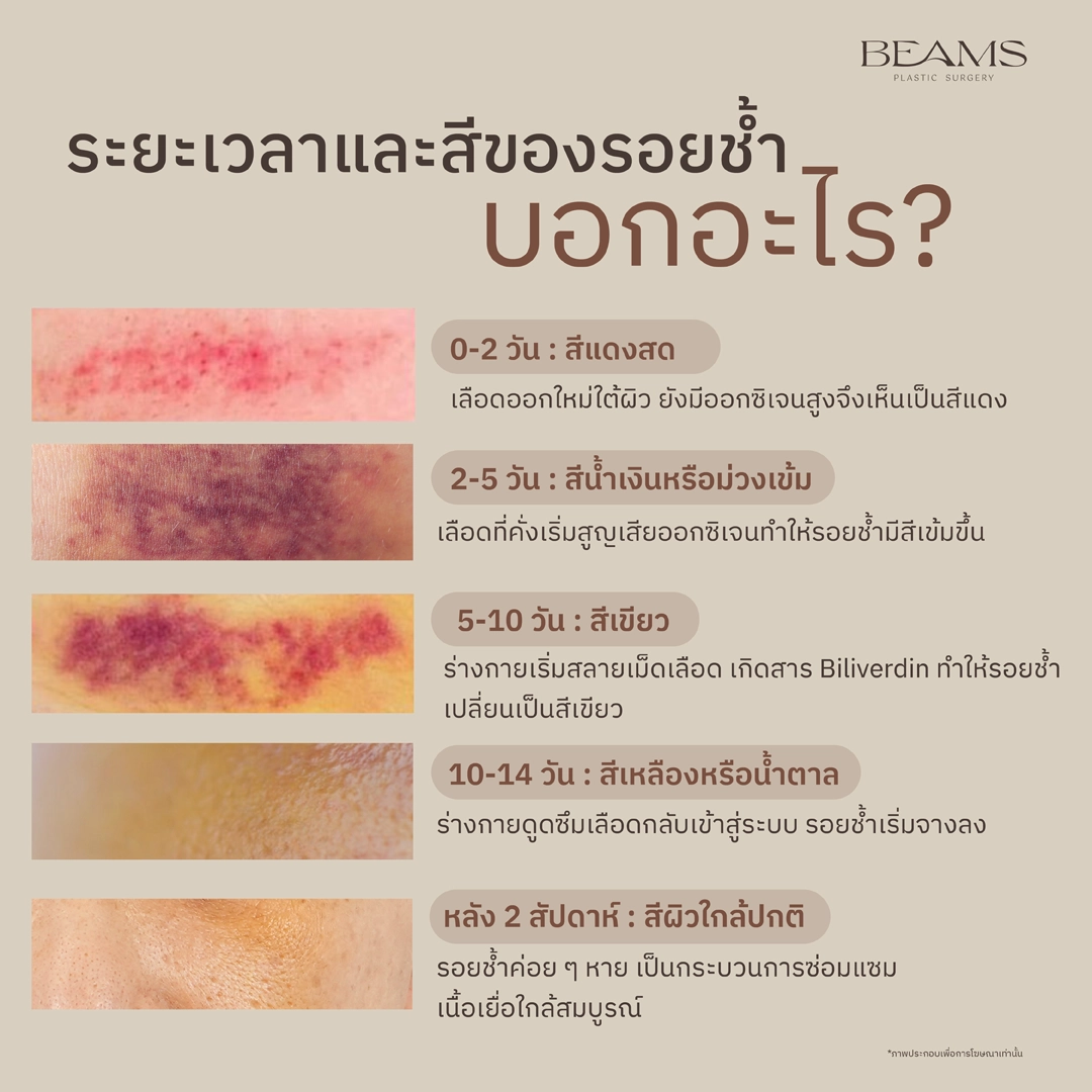 สีของรอยช้ำ