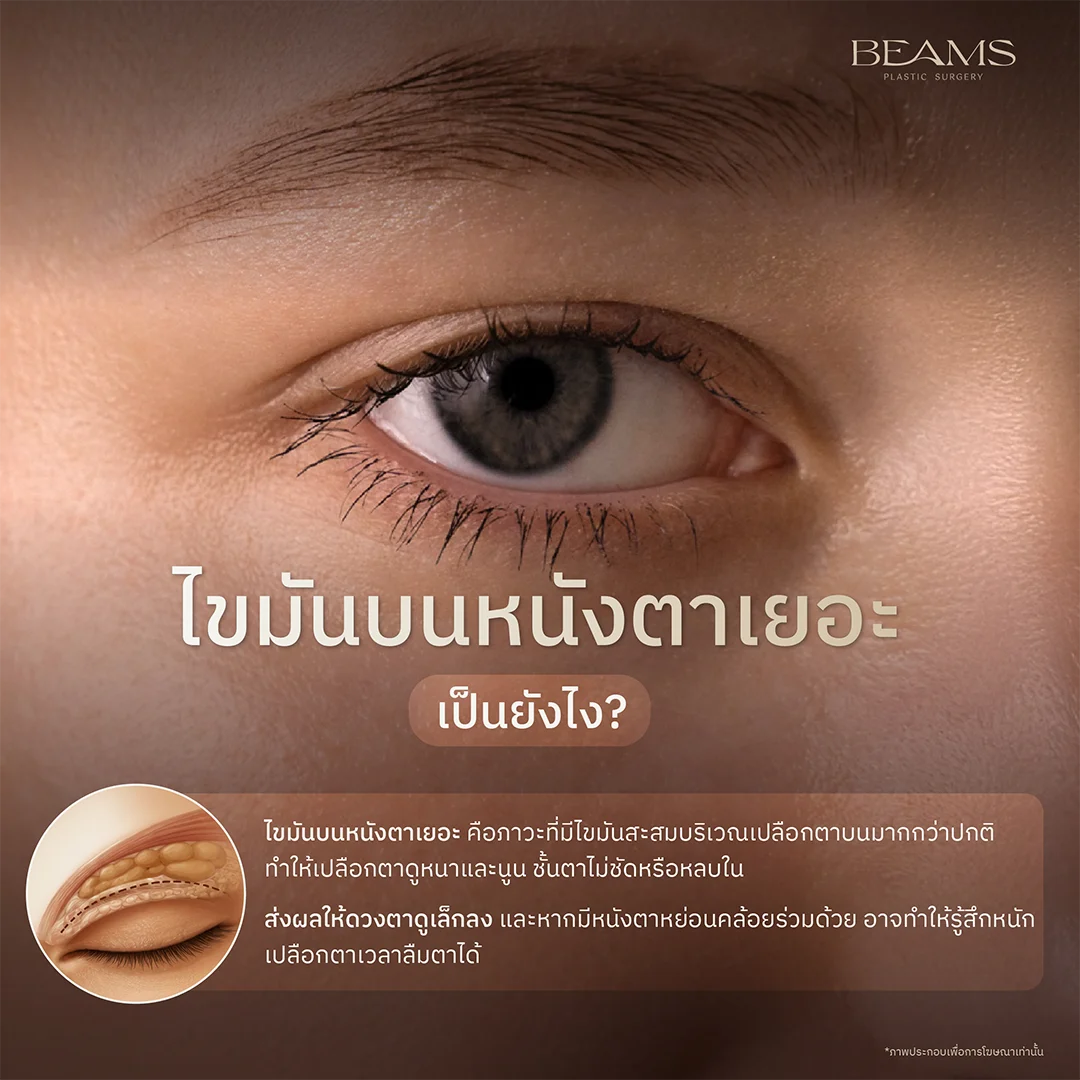 ไขมันบนหนังตาเยอะ เป็นยังไง