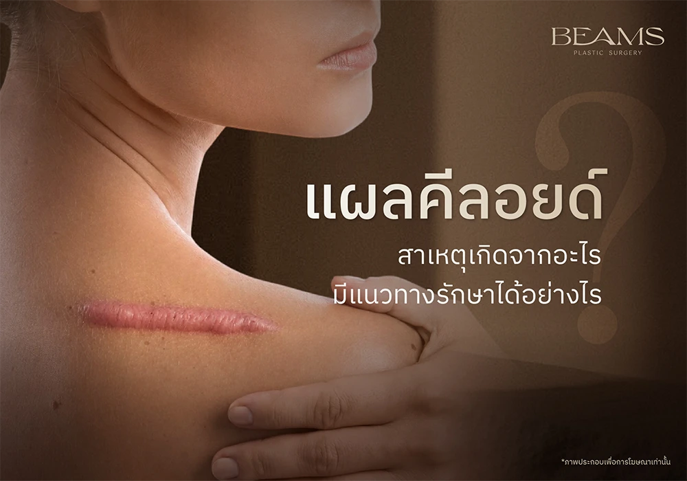 แผลคีลอยด์
