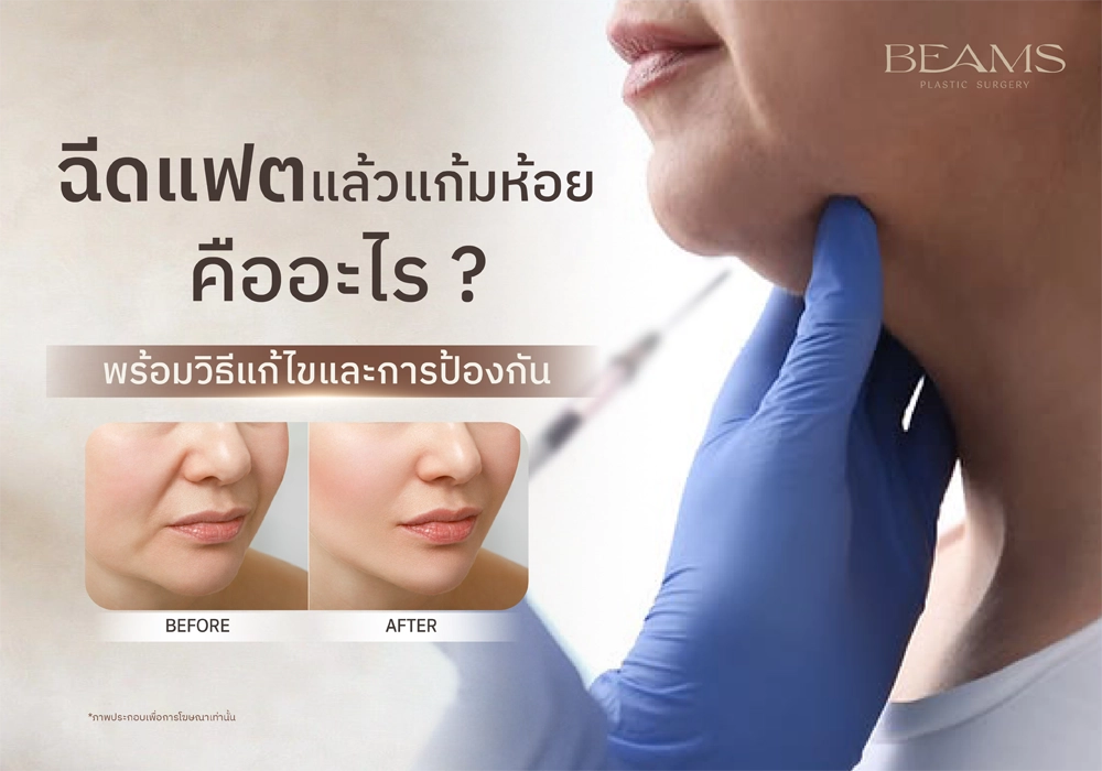 ฉีดแฟตแล้วแก้มห้อย