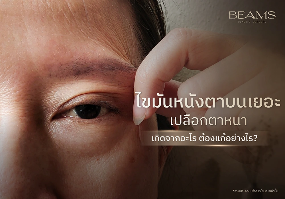 ไขมันหนังตาบนเยอะ