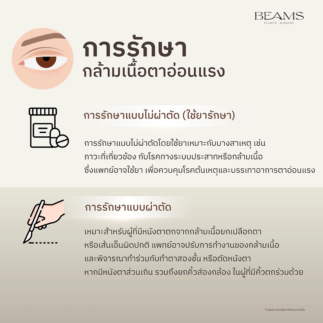การรักษากล้ามเนื้อตาอ่อนแรง