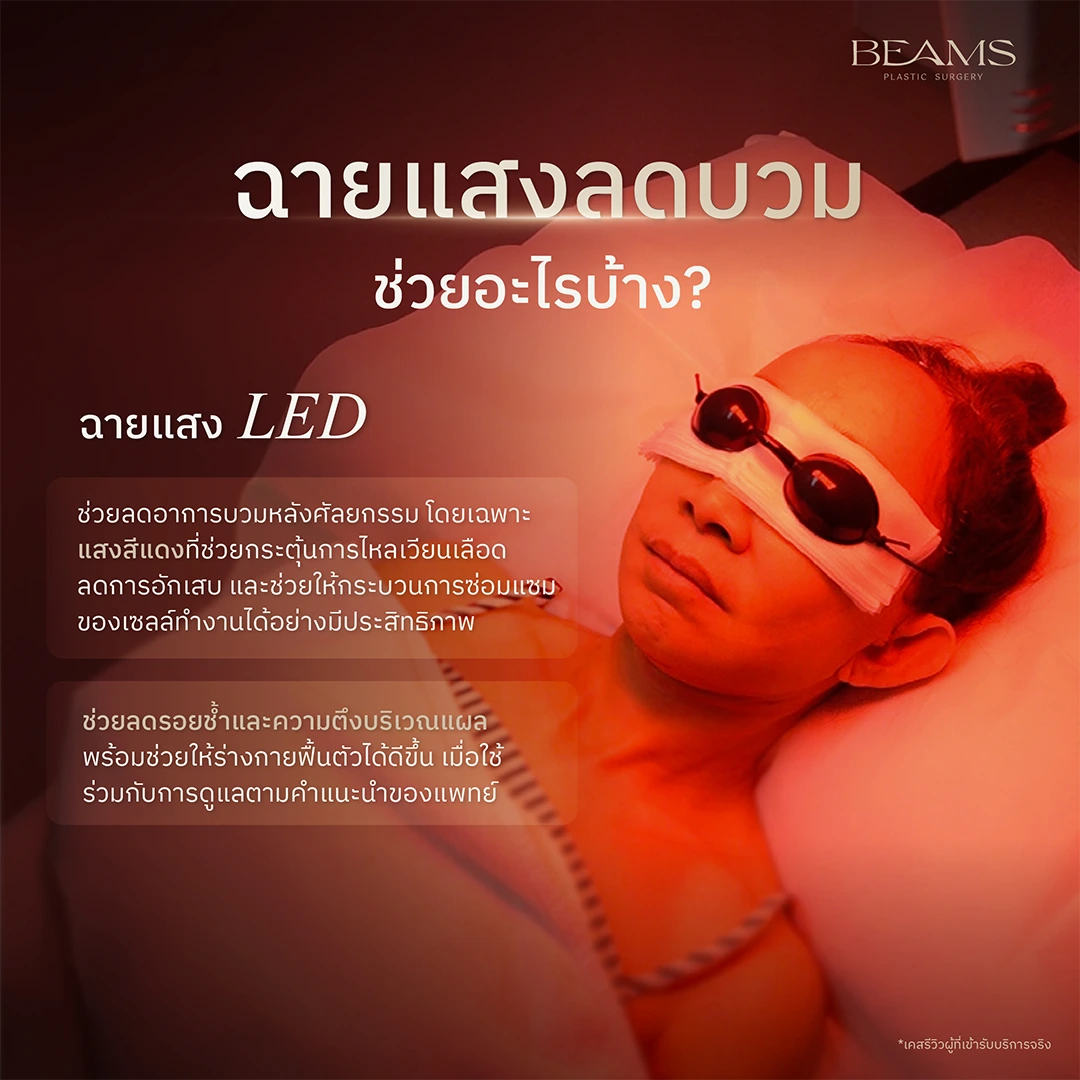 ข้อดีของการฉายแสงลดบวม