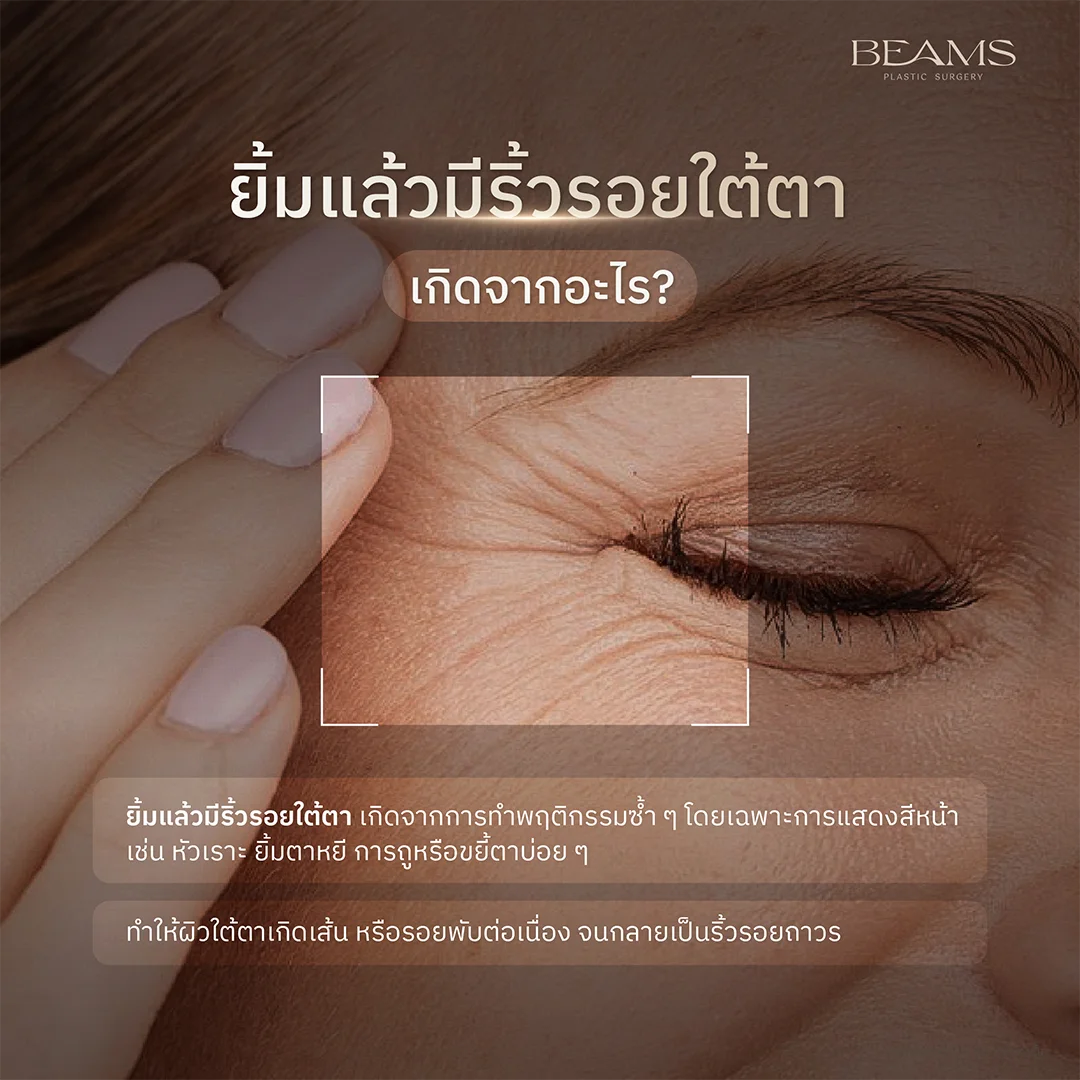 ยิ้มแล้วมีริ้วรอยใต้ตา