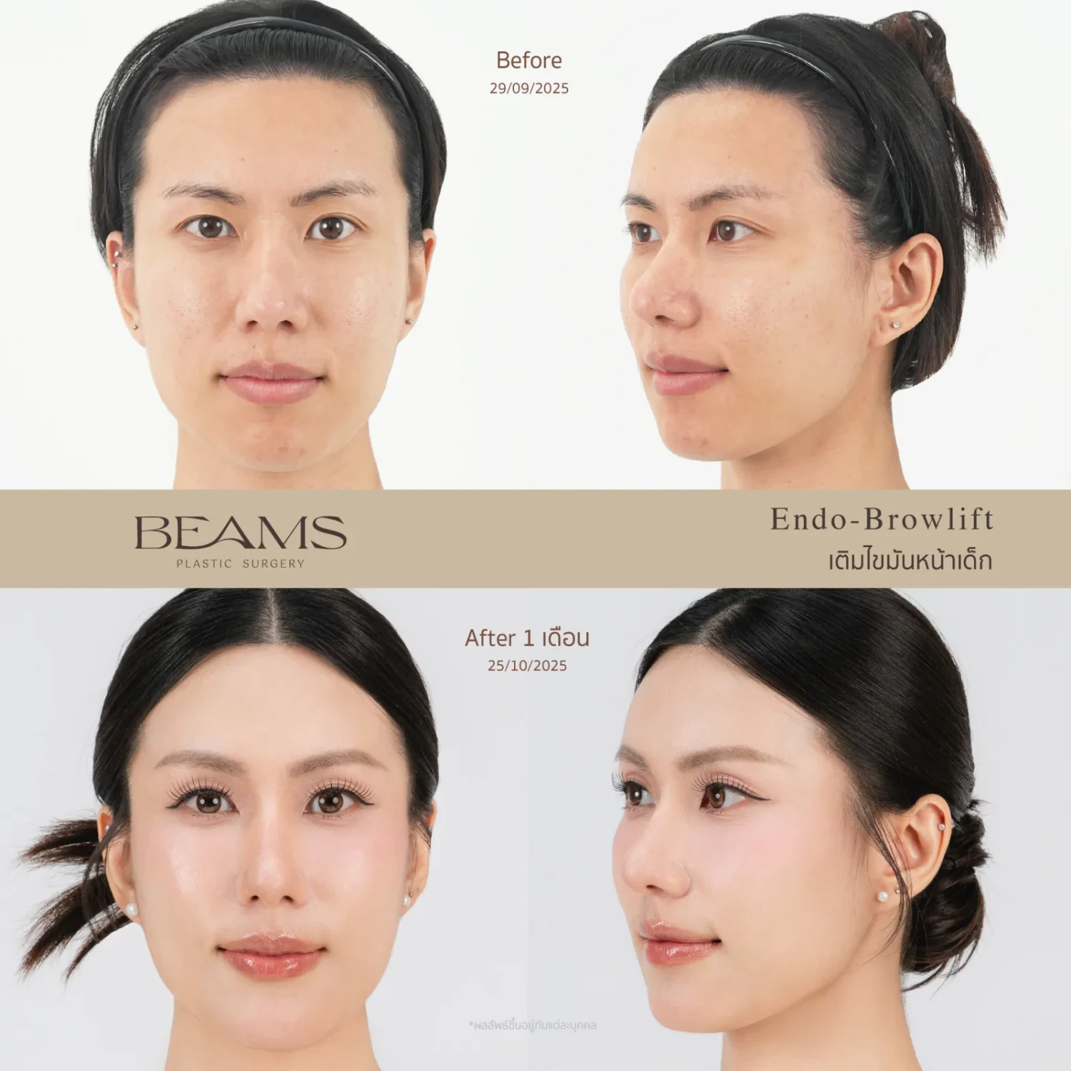 รีวิวฉีด Baby Fat