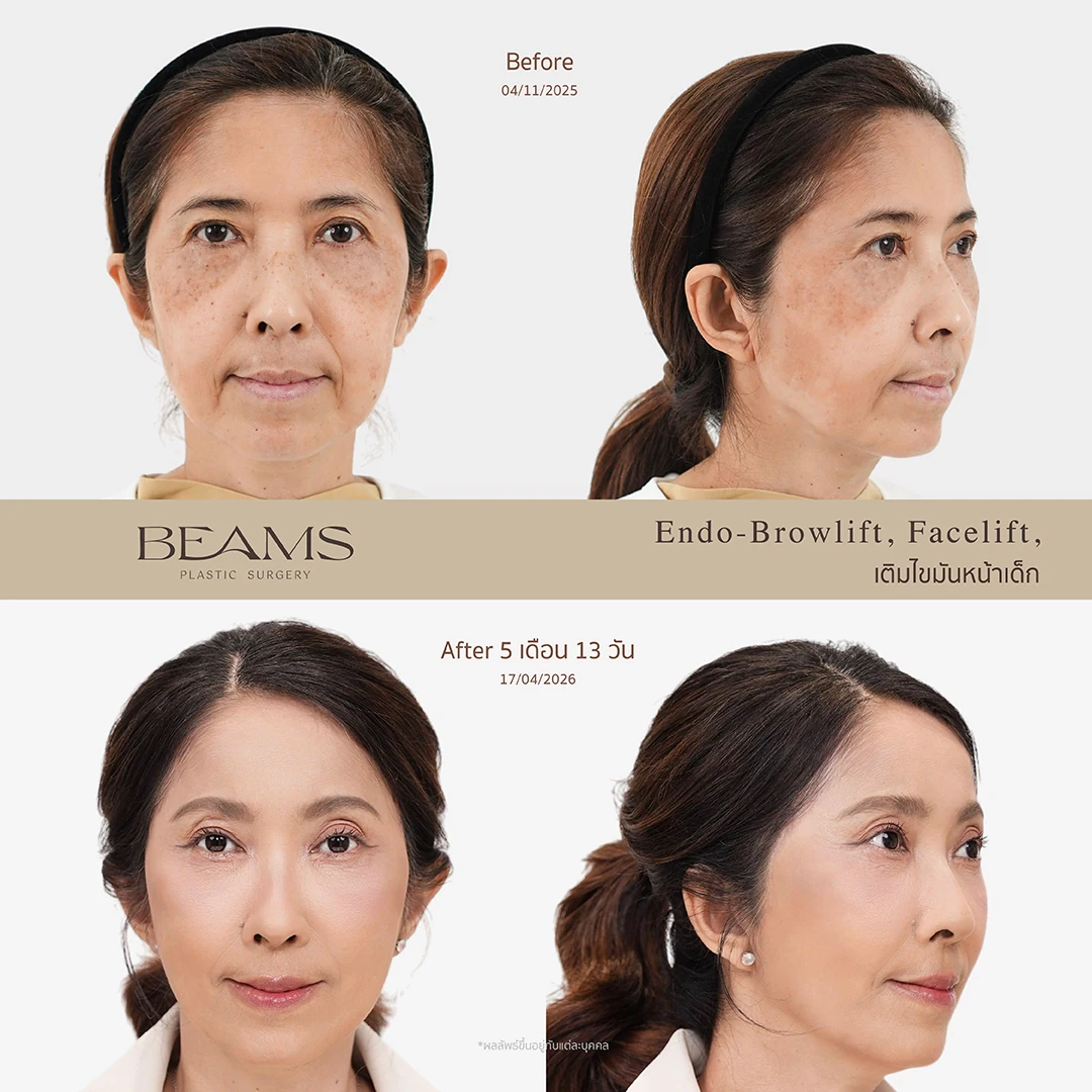 รีวิวฉีด Baby Fat ในผู้ใหญ่