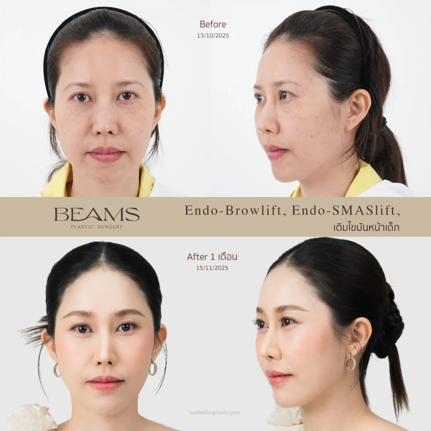 รีวิวฉีดเบบี้แฟต