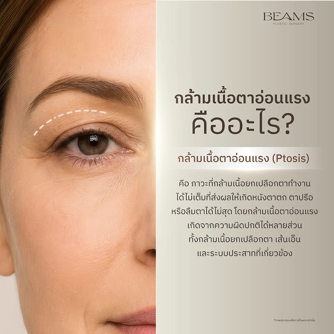 กล้ามเนื้อตาอ่อนแรง คืออะไร