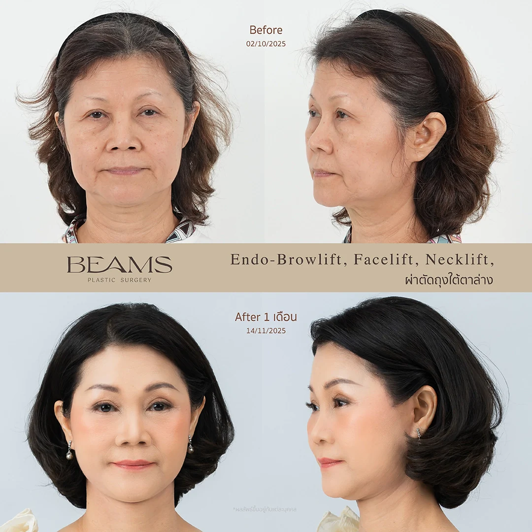 รีวิวดึงหน้า ยกคิ้วส่องกล้อง และแก้ปัญหาใต้ตา